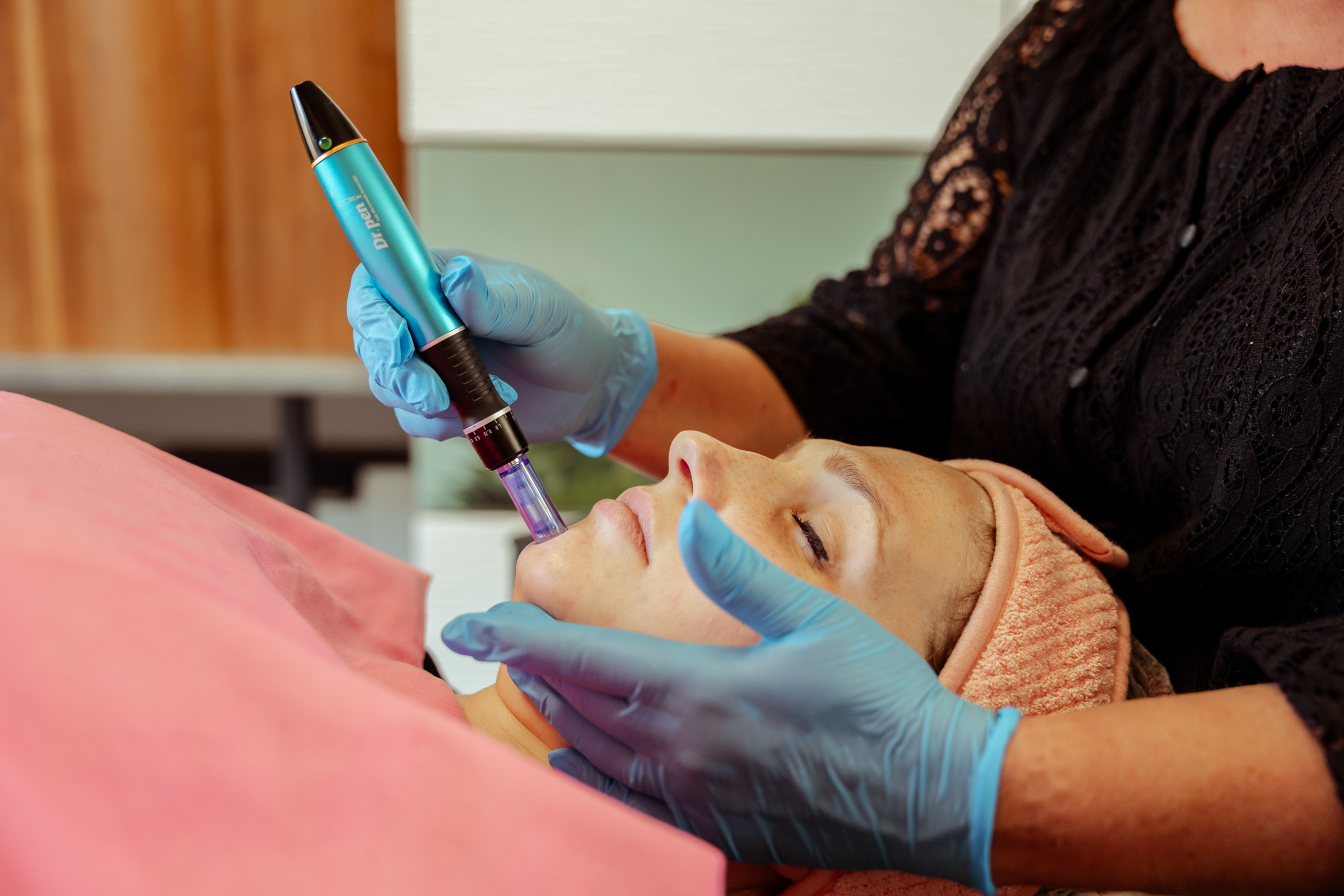 huidverbetering, meso micro needling