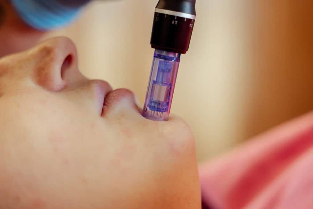 Meso Micro Needling pagina 02