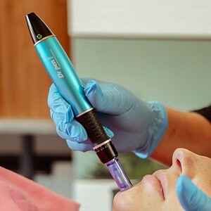Professionele microneedling behandeling voor huidverbetering.
